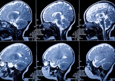 1 year baby MRI Brain Scan:leukodystrophy illness and developmental anomaly